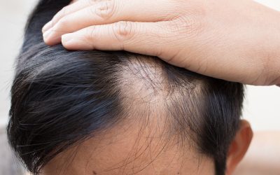 Restore Your Confidence with Hair Loss Restoration at Creekside